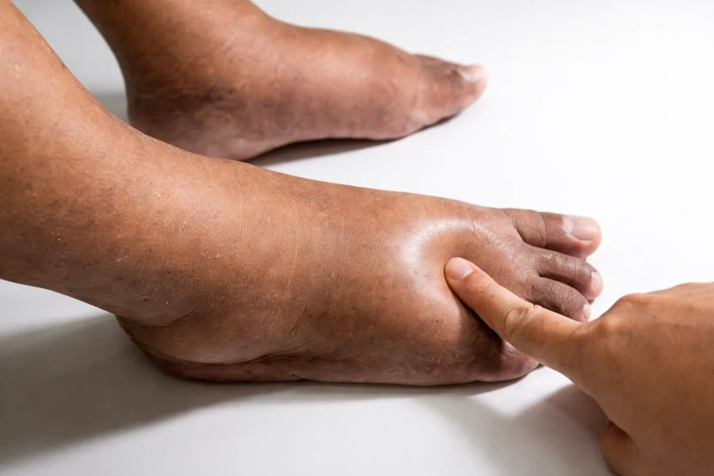 احتباس السوائل أم زيادة الدهون